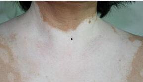 白癜风可以吃红瓜吗,适宜食用还是需谨慎？